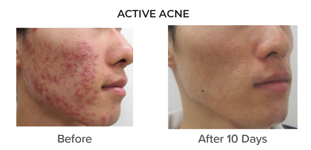 Active Acne, B&A, Ten Days